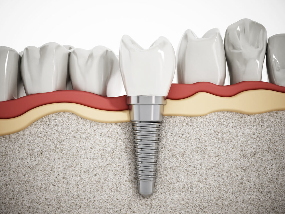 Illustration of a dental implant supporting a crown between natural teeth